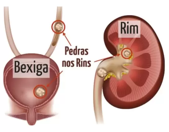 Cólica Renal e Cálculos Urinários