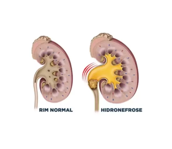 Cólica Renal e Cálculos Urinários