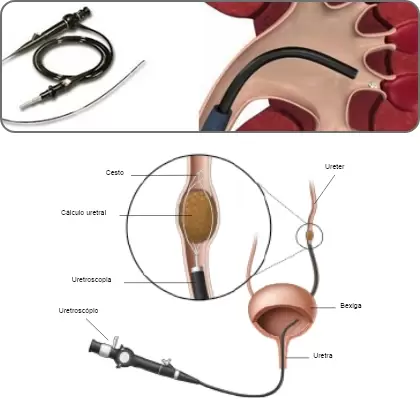 Ureterorrenolitotripsia flexível a laser