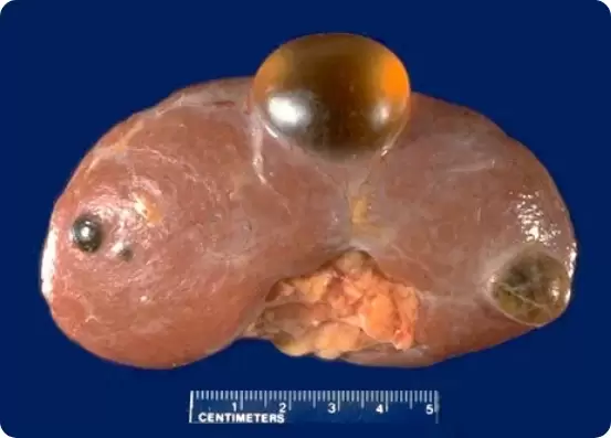 Mas um nódulo renal e um cisto renal são câncer de rim?