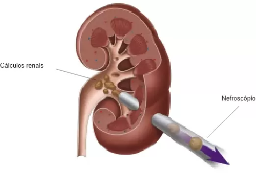 Nefrolitotripsia percutânea