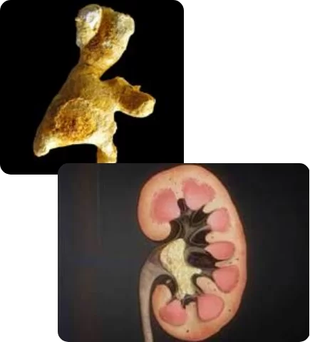 Nefrolitotripsia percutânea
